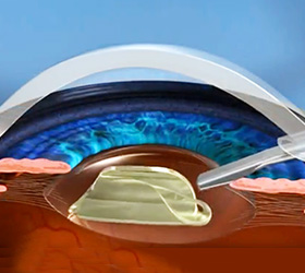 No-Blade Cataract Surgery