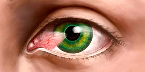 Pterygium