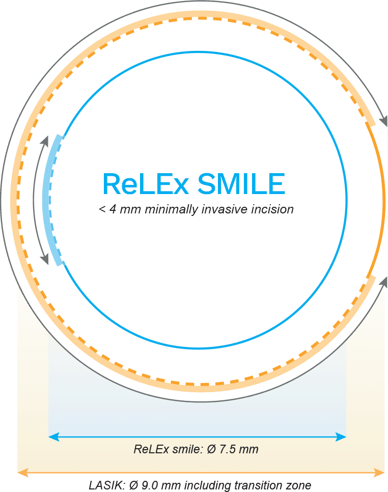 Rawatan Mata Relex Smile  Pusat Pakar Mata u0026 Lasik OPTIMAX Malaysia