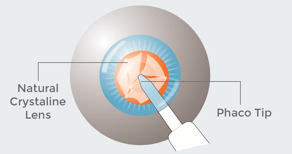 Refractive Lens Exchange RLE