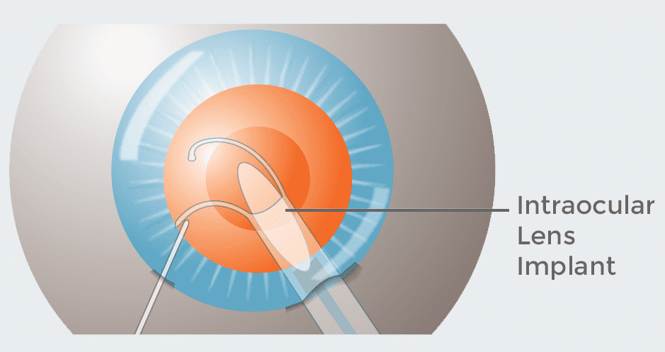 Refractive Lens Exchange RLE